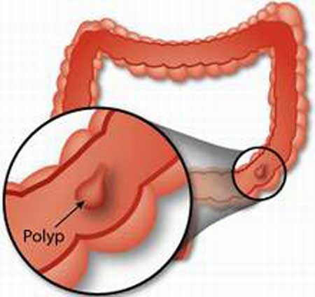 Polyp ống tiêu hóa
