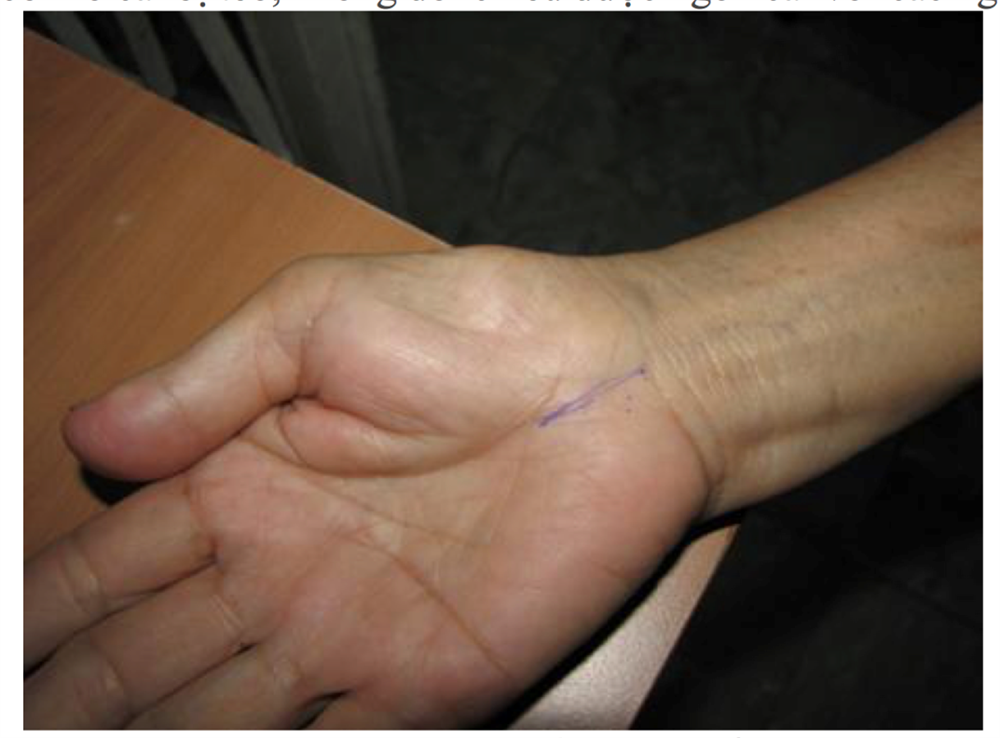 Tê bì ngón tay – Có thể do Hội chứng ống cổ tay (Carpal tunnel syndrome)